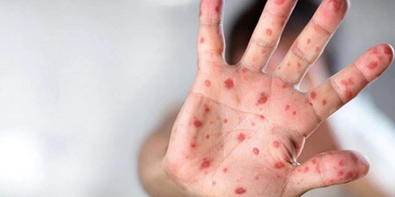 Covid-19'un çıktığı Çin'den Mpox için akıl almaz tedbir