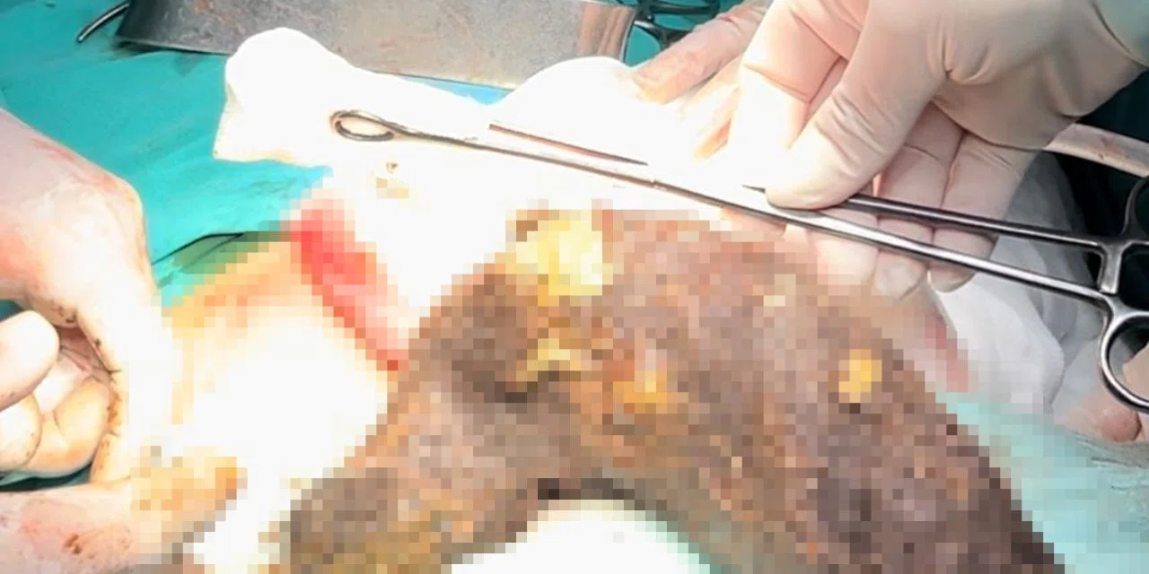 Karın ağrısıyla ameliyata girdi: Midesinden çıkanlar doktorları şoke etti