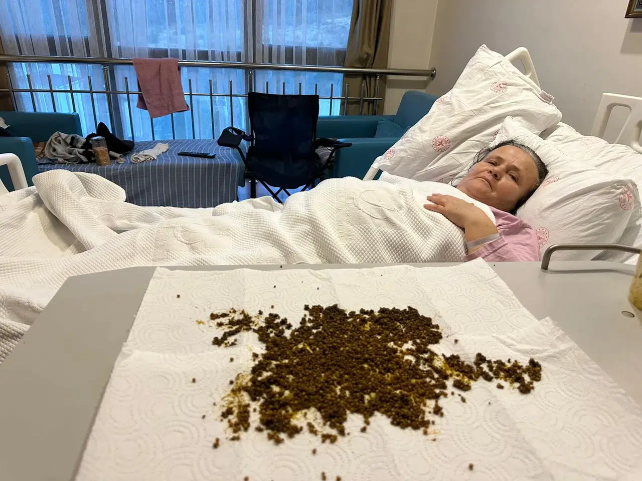 Doktorlar şok oldu: Hastadan çıkan taşları sayamadılar