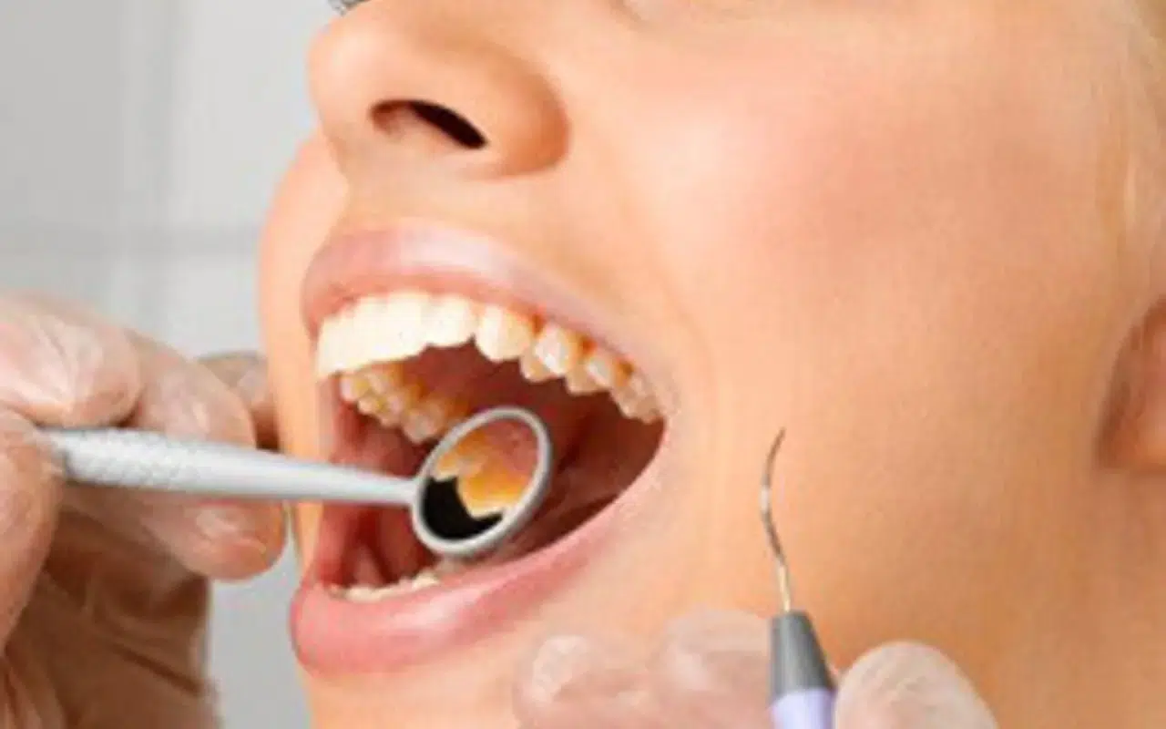Dişçi korkusu ve dolgusu tarih oluyor: Diş çürüğüne neştersiz çare