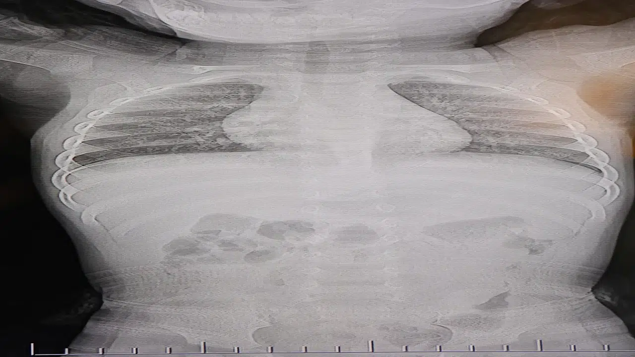 Böylesi görülmedi: 1 yaşındaki bebeğin sırtından zımba teli çıktı