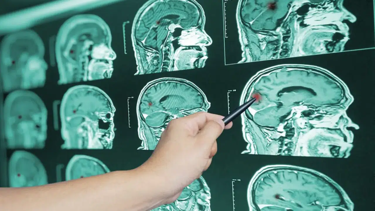 Beyin sapı kanaması öldürür mü: Kan sulandırıcı ilaç kullanırken bir kez daha düşünün