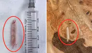 Dünya şaşkın: Kalçasına saplanan termometre ile 22 yıl yaşadı