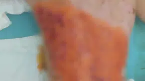 Akran zorbalığında gelinen nokta: Çocuğun sırtını kolonya ile yaktılar