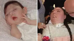 Beyni olmadan dünyaya gelmişti: Doktorlar '5 yıl bile yaşamaz' dedi, o 20 yaşında