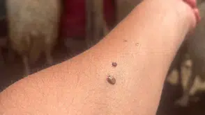 Konya'da kene alarmı: Bir kişi hayatını kaybetti