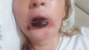 Dolgu dudağı ve yüzü çürütür mü: Estetikte yeni tehlike