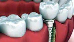 Nasıl anlaşılır: Vatandaşa kaçak ve sahte implant takılıyor
