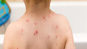 Okullarda suçiçeği salgını: İdare çaresiz veliler tedirgin