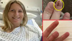 Tırnak kanserine dikkat: O çizgiler ölümcül olabilir
