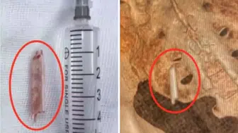 Dünya şaşkın: Kalçasına saplanan termometre ile 22 yıl yaşadı