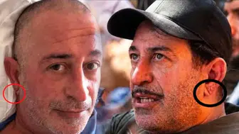 Cem Yılmaz'ın kulağı olay oldu: Frenk çizgisi kalp krizi habercisi