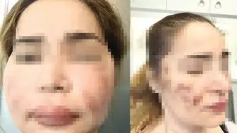 Ucuz estetik öldürüyor: Kapanmayan yaralar, bitmeyen masraflar
