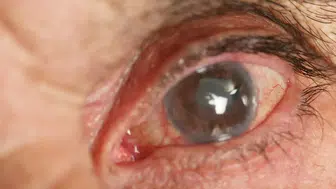 "Katarakt ameliyatı" deyip geçmişti: Adeta hayatı karardı