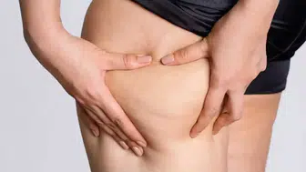 Diyet ve egzersize rağmen incelmeyen bacaklar: Uzmanından uyarı geldi