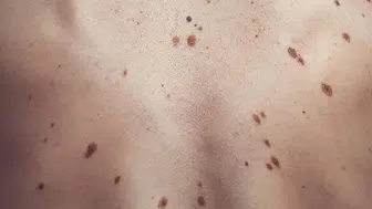 Bedeninizdeki benlerin değişimine dikkat: Alfabetik renk değişimi riski