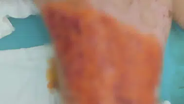 Akran zorbalığında gelinen nokta: Çocuğun sırtını kolonya ile yaktılar