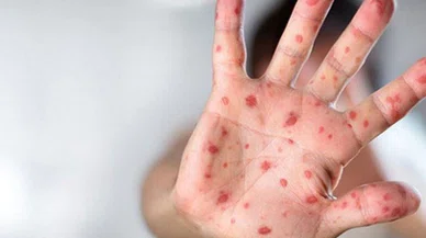 Covid-19'un çıktığı Çin'den Mpox için akıl almaz tedbir
