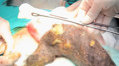 Karın ağrısıyla ameliyata girdi: Midesinden çıkanlar doktorları şoke etti