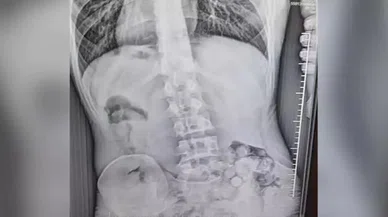 Otobüs yolcusunun midesinde uyuşturucu yakalandı: 309 gram metamfetamin