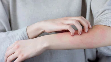 Dermatoloji uzmanları uyarıyor: Gözden kaçırılan 2 belirti cilt kanseri işareti