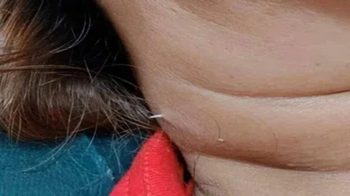 Nasıl bir balıksa: Yuttuğu balık kılçığı boynundan çıktı