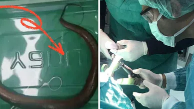 Karnından çıkan doktorları hayrete düşürdü