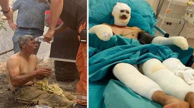 "Yanıyorum" demişti: Orman işçisinin tedavisi sürüyor