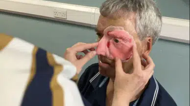 3D yazıcıyla yeniden yapıldı: Kazada yüzünün yarısını kaybetmişti