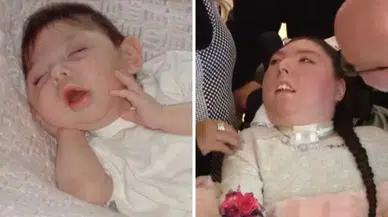 Beyni olmadan dünyaya gelmişti: Doktorlar '5 yıl bile yaşamaz' dedi, o 20 yaşında