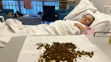 Doktorlar şok oldu: Hastadan çıkan taşları sayamadılar