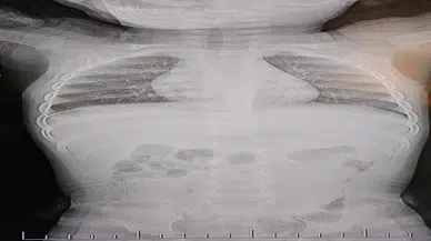 Böylesi görülmedi: 1 yaşındaki bebeğin sırtından zımba teli çıktı