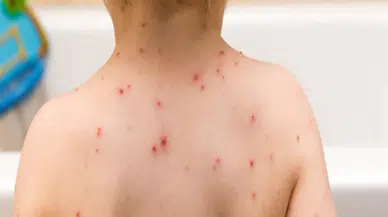 Okullarda suçiçeği salgını: İdare çaresiz veliler tedirgin