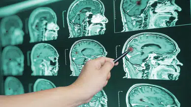 Beyin sapı kanaması öldürür mü: Kan sulandırıcı ilaç kullanırken bir kez daha düşünün