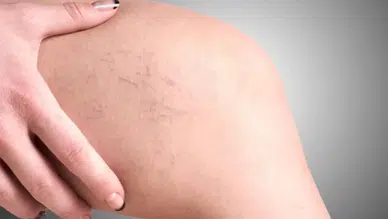 Hastalık mı, varis çorapları işe yarar mı: Bacaklarımızdaki mavi mor çizgiler
