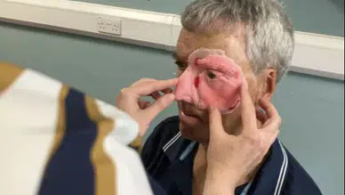 3D yazıcıyla yeniden yapıldı: Kazada yüzünün yarısını kaybetmişti