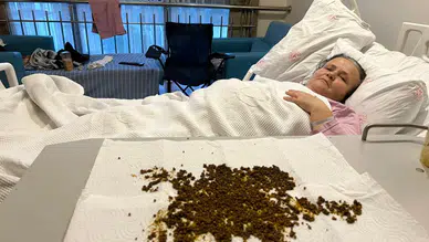 Doktorlar şok oldu: Hastadan çıkan taşları sayamadılar