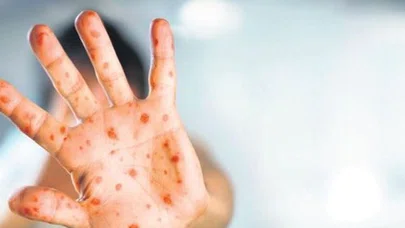 Nijerya'da maymun çiçeği virüsünden ölenlerin sayısı 12'ye çıktı