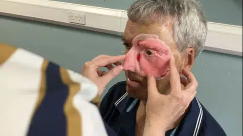 3D yazıcıyla yeniden yapıldı: Kazada yüzünün yarısını kaybetmişti