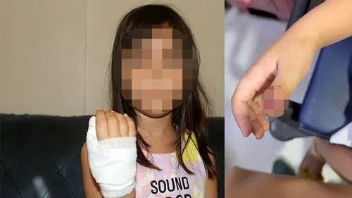 Anaokulunda dehşet: Dört yaşındaki çocuğun parmağı koptu