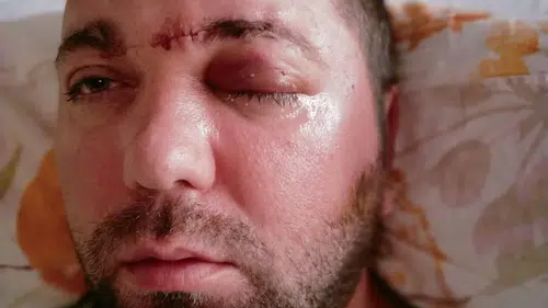Diş yaptıracaktı: Beynine saplanan implant hayatını kabusa çevirdi