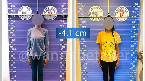 Akılalmaz trend: Boy kısaltmak turizmi başladı
