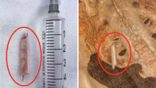 Dünya şaşkın: Kalçasına saplanan termometre ile 22 yıl yaşadı