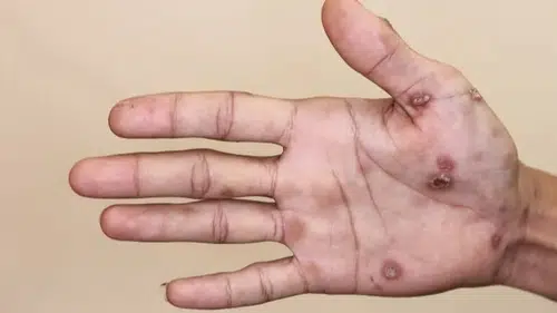 Frengi ve gonore salgını. O ülkeye en çok Türkler gidiyor