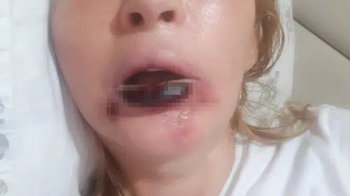 Dolgu dudağı ve yüzü çürütür mü: Estetikte yeni tehlike