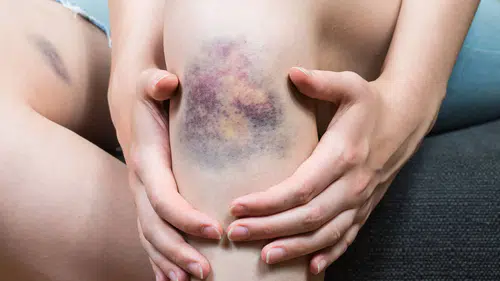 Kan pıhtılaşması öldürücü mü: Genetik yatkınlık, hareketsizlik, sigara kullanımı, obezite
