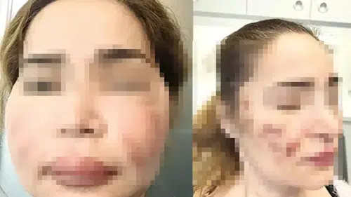 Ucuz estetik öldürüyor: Kapanmayan yaralar, bitmeyen masraflar