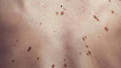 Bedeninizdeki benlerin değişimine dikkat: Alfabetik renk değişimi riski