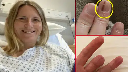 Tırnak kanserine dikkat: O çizgiler ölümcül olabilir