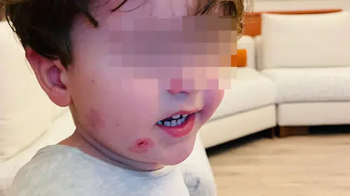 Kreşte skandal: 2,5 yaşındaki çocuk bu hale geldi